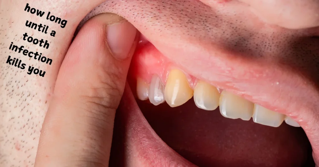 how long until a tooth infection kills you